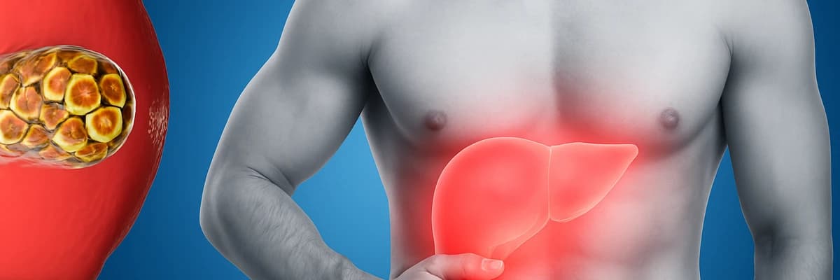 Image de l'article Gamma GT élevé sans alcool : causes et solutions efficaces